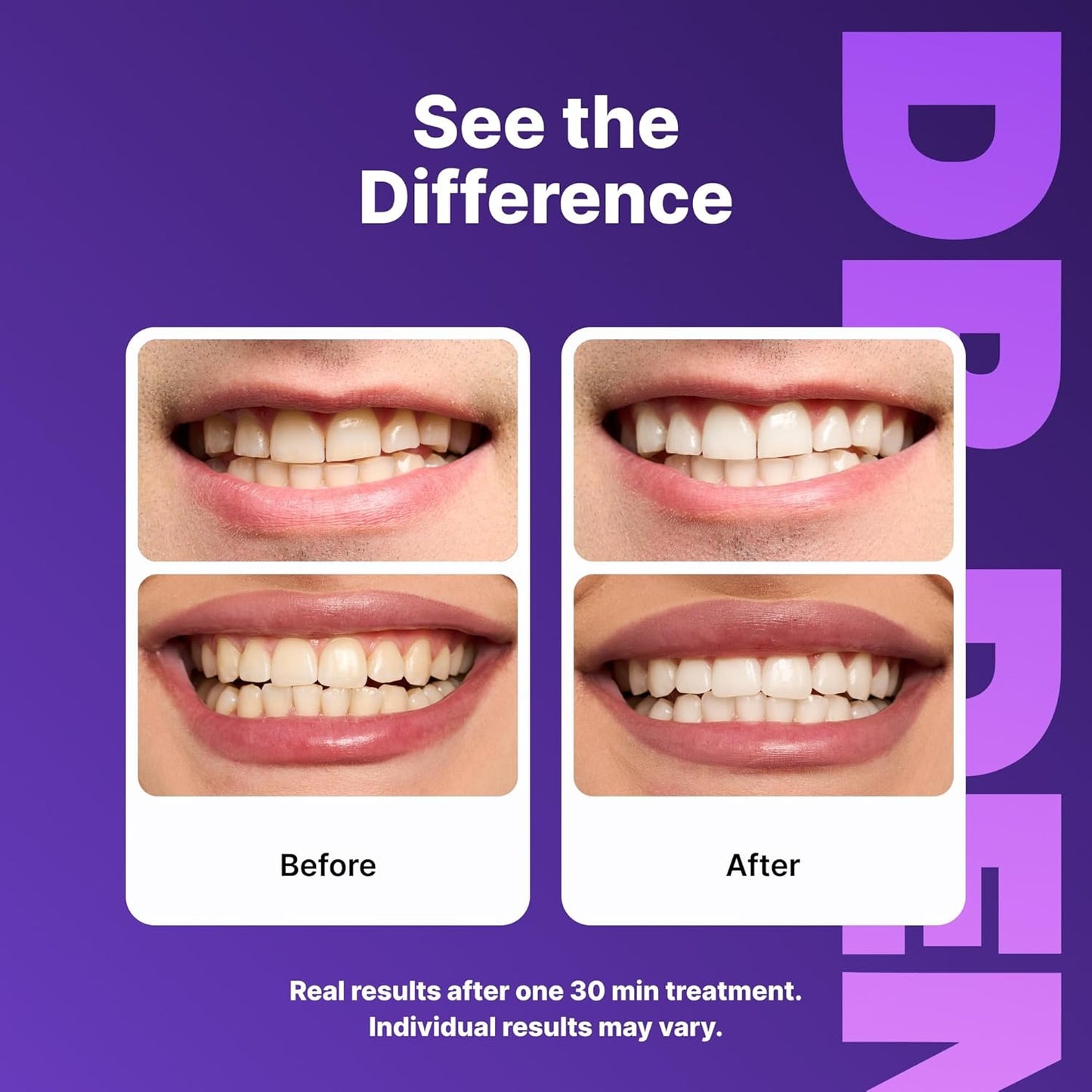 DR.DENT Teeth Whitening Strips – Peroxide-Free Whitening for a Brighter, More Confident Smile